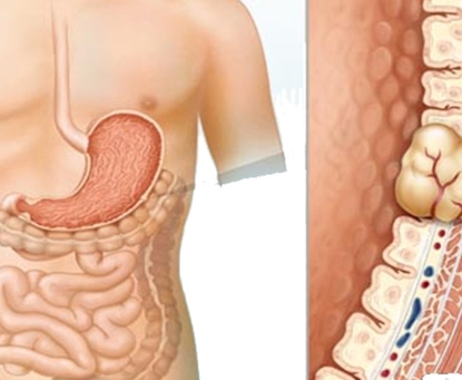 Khối u mô đệm đường tiêu hóa(GIST) có cần phẫu thuật hay không?